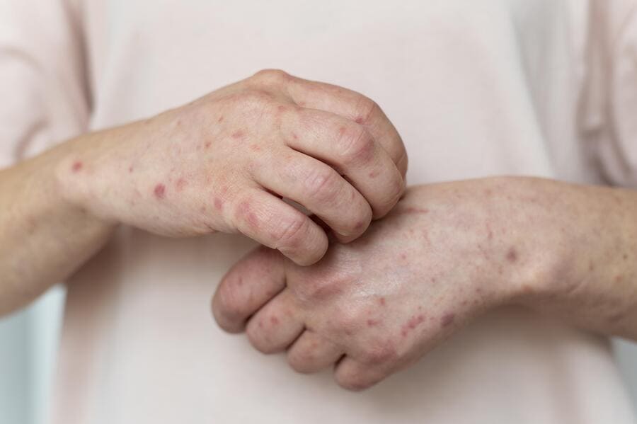 roseola sifilítica